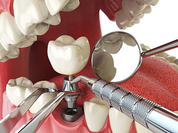 Best Emergency Dentist for Knocked-Out Tooth in Mission Hills, KS